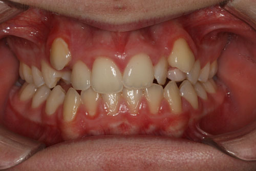 Before Orthodontic Treatment
