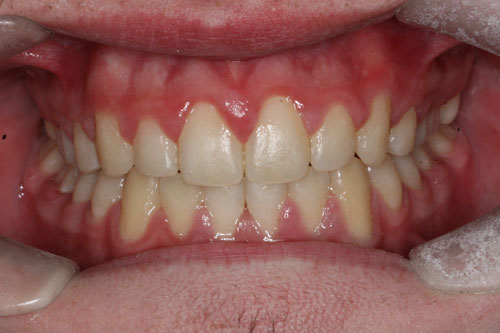 After Orthodontic Treatment